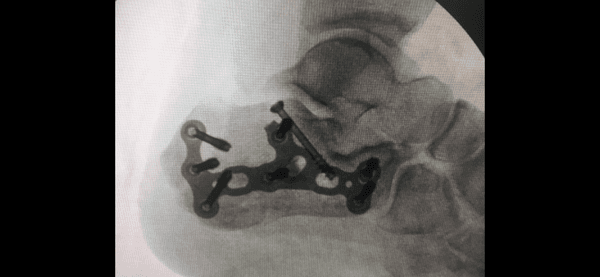 Reduction and fixation of a calcaneal (heel bone) fracture after fall from height.