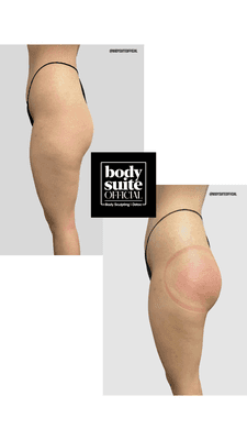 Before & After our non-invasive BBL! Large suction cups are used to help add a natural plump and volume to shape your buttocks!