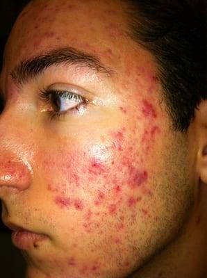 Specialized in teenage acne treatments.