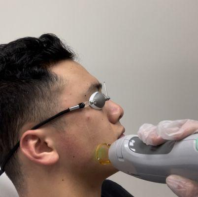 laser hair removal face