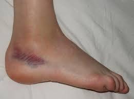 Ankle sprain