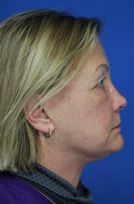 69 year-old patient 5 weeks after facelift