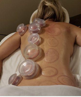 Traditional Chinese Cupping