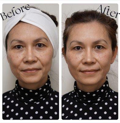 This beauty had Our Non-Surgical Facelift done, triLift offers a lifted look that requires no needles and no downtime. 
No surgery