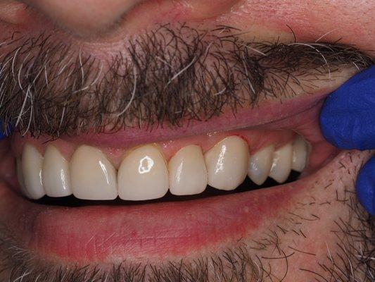 veneers, no preparation on teeth!