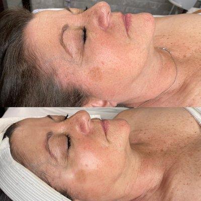 Anti Aging Facial