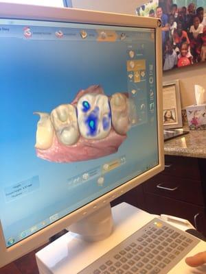 Getting a custom made porcelain crown using fancy technology that took 3D images of my mouth. Crown is make in like 20 mins.