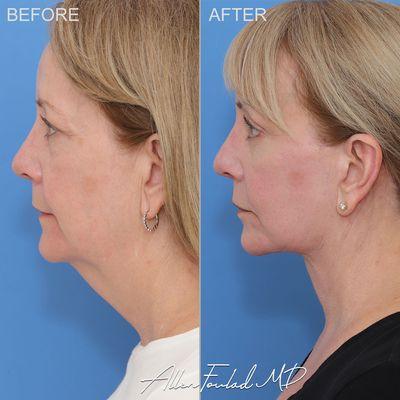 Deep plane lower facelift and neck lift with platysmaplasty, lateral brow lift, upper eyelid and lower eyelid blepharoplasty.