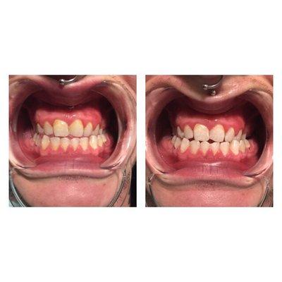 Before /after teeth whitening