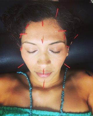 Acupuncture for Facial Rejuvenation and headache