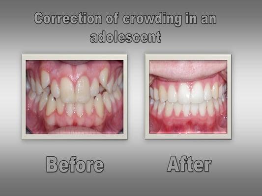 Denver Orthodontist | Kids & Adult orthodontics Denver