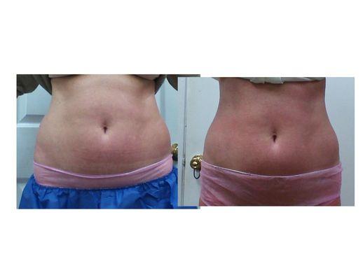 Cavitation Lipo Before & After