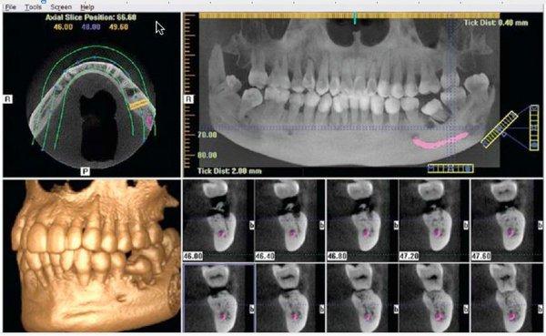 We use the latest in Low Radiation CBCT Scanning Technology to diagnose conditions