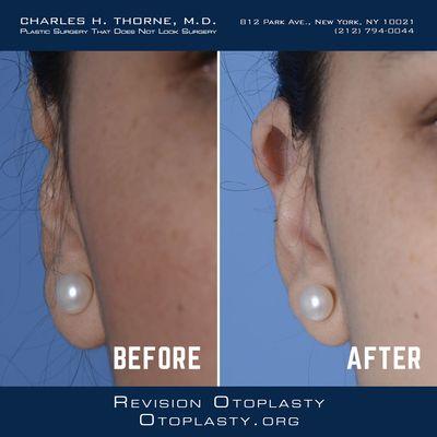 Otoplasty.org: Revision Otoplasty Before & After Images