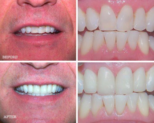 Smile makeover with Custom porcelain crowns