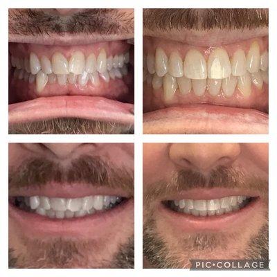 Before and after pictures of Invisalign with Dr. Moran