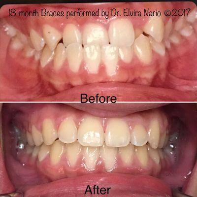 18-month Braces performed by Dr. Elvira Nario