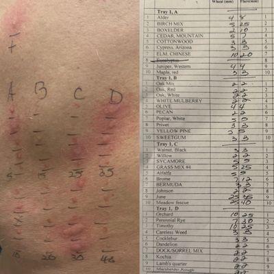 Partial results of my back skin test... several possible allergens are tested and the results are given back to you.