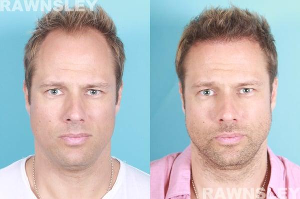 Hair Transplant Before & After | Rawnsley Hair Restoration