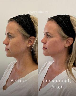 Liquid facelift