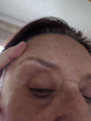 See line if broken skin and redness after threading