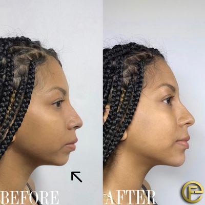 Chin Augmentation  to promote more facial balancing.