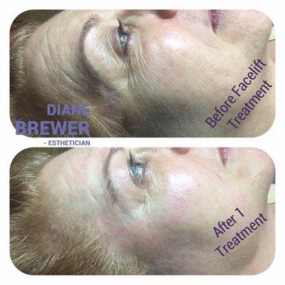 Non-Surgical Facelift Facial