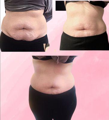 Body Sculpting fat melting laser lipo