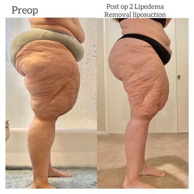 Before and after 2 Lipedema removal surgeries