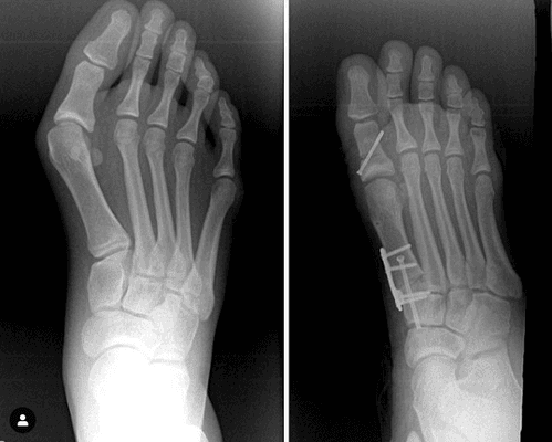 Bunion Surgery