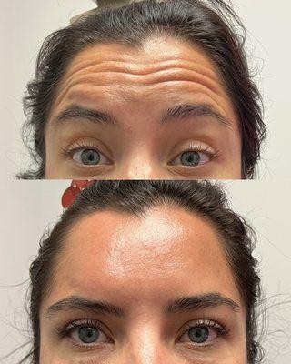 Botox treatment on the frontalis. Units will vary for each patient.