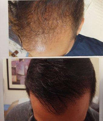 Actual patient of mine for hair loss.  Received 4 treatments of PRP injections with amazing results.