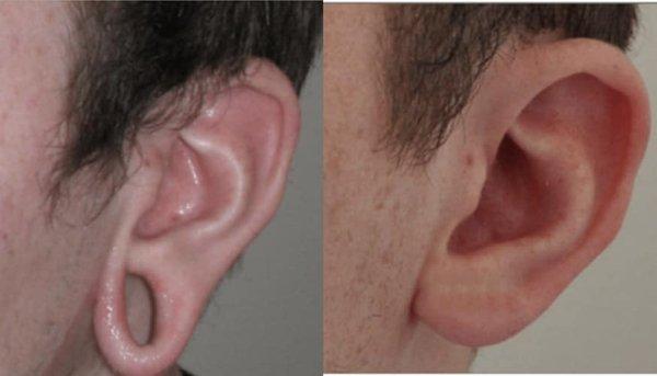 Before and After Ear Repair Surgery | Dr. David Feldmar of Feldmar Aesthetics Beverly Hills, CA