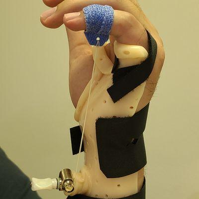 Custom hand orthosis to improve movement