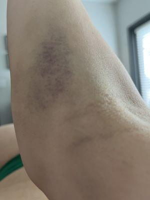 Day 4 bruising