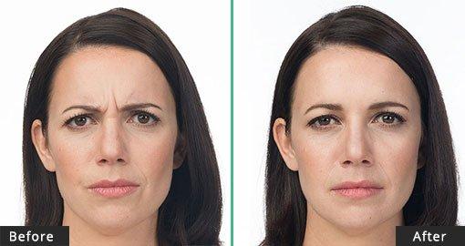 Botox Cosmetic Before/After