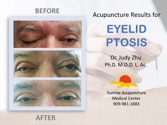 Great results on an eyelid ptosis case showing full recovery after acupuncture treatment.