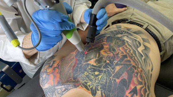 Need just part of your tatt removed? We can help!