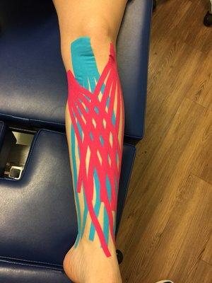 Edema taping for shin splints.