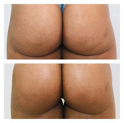 non-surgical Blooming Butt Lift BBL