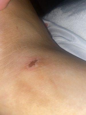 Other foot from using pumis stone on my other ankle