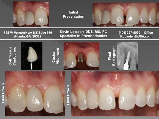 Implant Crown Lateral Incisor   Creating Function & Form   Predictably