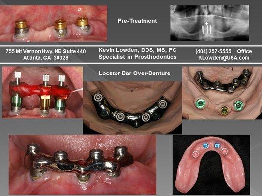 Implant Over Denture   Denture 'Snaps' into place   Restoring Patient Confidence