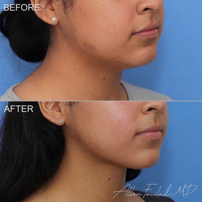 Minimal Incision Deep Sculpting (MIDS PLUS) Neck Lift with Gland Reduction.