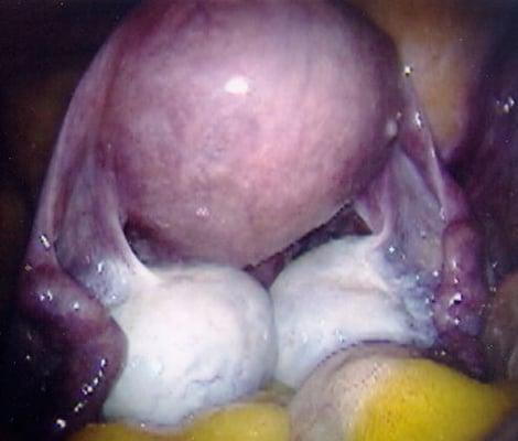 Laparoscopy showing a normal uterus and polycystic ovaries.