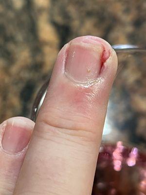 Nail Spa Excel finger damage - 15 days after a botched manicure