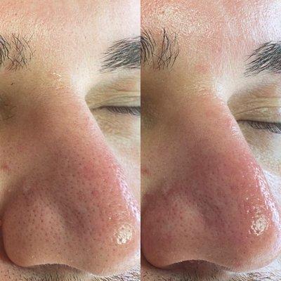 Before and after Luna Luce Facial