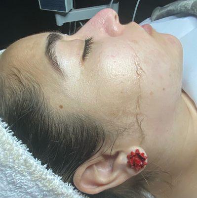 Dermaplaning