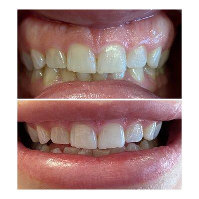 Teeth whitening- 60 minute session