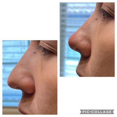 Injection rhinoplasty